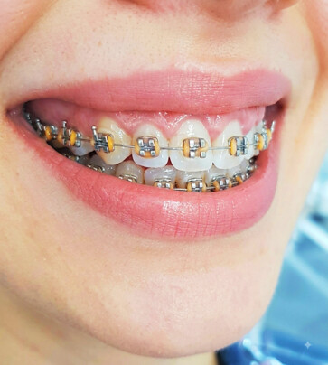 Sorriso com aparelho dentário ortodôntico