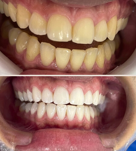Dentes antes e depois do clareamento dental