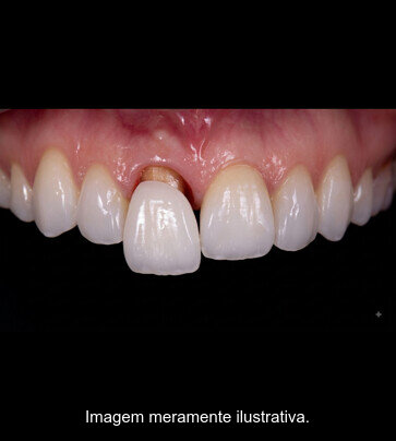 Coroa dentária cerâmica sobre dente preparado