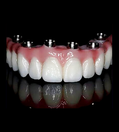 Prótese sobre implantes dentários